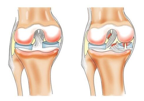 gjuri i shëndetshëm dhe artroza e kyçit të gjurit
