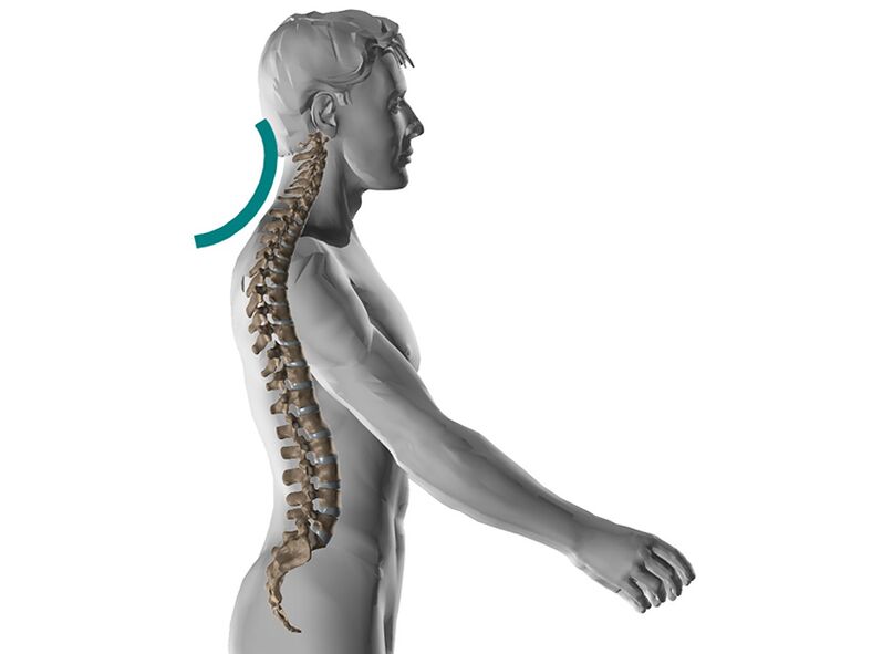 Osteokondroza cervikale e shtyllës kurrizore, duke shkaktuar shumë simptoma të pakëndshme